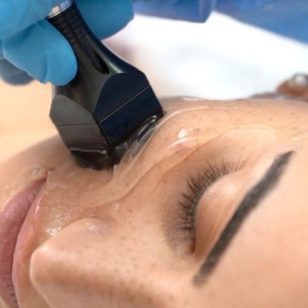 A trained clinical therapist using a genuine InMode Forma handpiece to glide over a client's cheek during a radiofrequency skin tightening session