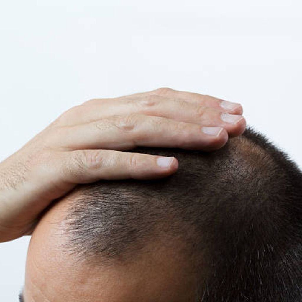 QR678 Neo hair treatment consultation in Bengaluru: a patient assessing scalp thinning before non-surgical hair density restoration across Transform Head to Toe practice locations in Indiranagar, Bellandur, Koramangala, and Cunningham Road