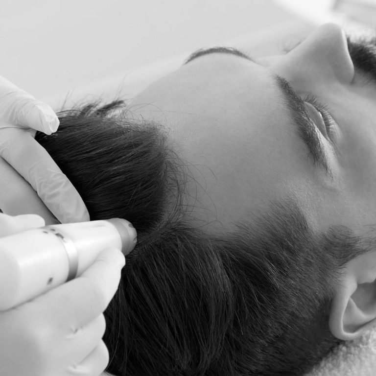 GFC hair growth treatment in Bengaluru: precision Growth Factor Concentrate therapy administered to a male patient's scalp by IADVL dermatologists at Transform Head to Toe clinics in Indiranagar, Sahakarnagar, Bellandur, and HSR Layout